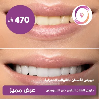 (تبييض الأسنان بالقوالب المنزلية)لدى مجمع طريق العلاج الطبي حي السويدي